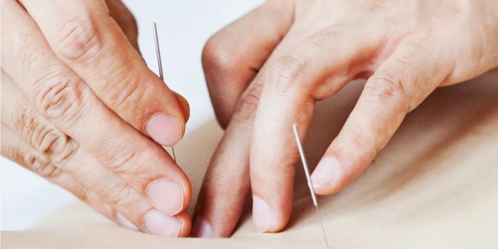 Acupuncture needles medicine brief traditional chinese history lightbox create closeup cork inserted into